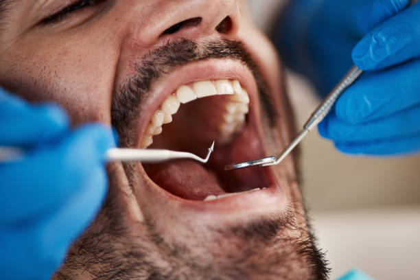 Best Emergency Dentist for Lost Fillings or Crowns in Schertz, TX